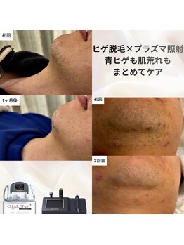 マウム(Maum)の写真/看護師監修◎ヒゲ脱毛で清潔感と自信を♪