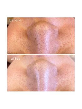 アクアンフィニィ(aquanfini)/気になる毛穴のお悩みを改善