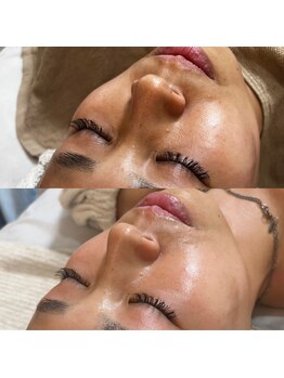 ラウレア(LAULEA)/カーボキシー炭酸パック