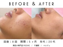 ロエヴェ(ROEWE)/ニキビ改善・毛穴ケア・肌質改善