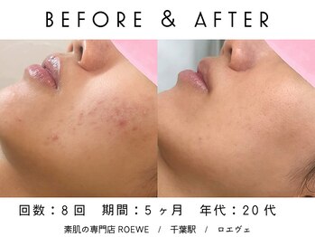 ロエヴェ(ROEWE)/ニキビ改善・毛穴ケア・肌質改善