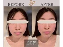 チョコバリ 新宿店(chocobari)/小顔×リフトアップ(美容鍼)20代