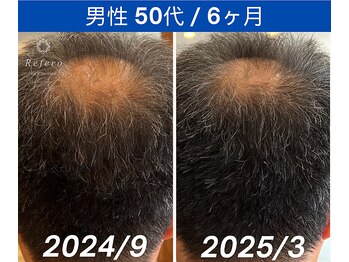 リフェロ 豊橋店(Refero)/Refero6本使用変化