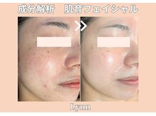 リン(Lynn)/【フェイシャル】