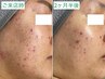 【ニキビ・肌荒れ改善】菌を調整バリヤ機能修復で憧れの美肌！通常16,500円→