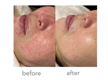 ペネロープ 緑井店(penelope)の雰囲気(【酒さ】50代女性)