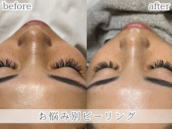 ミック(Mecc)/お悩み別ピーリング60分