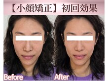 リラハウス(Lila House)の雰囲気（[４０代女性]施術回数１回下に伸びたお顔でお悩みBefore-After）