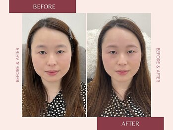 ナキ 富山店(Naki)/眉毛施術例 (眉毛Before.After)