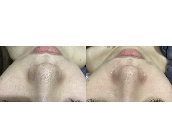 ルボン(RUBON)/ 鼻WAX＋ピーリング＋毛穴洗浄