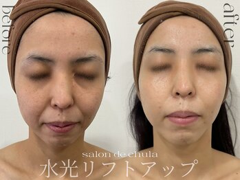 サロンドチュラ(salon de chula)/水光リフトアップ/ほうれい線