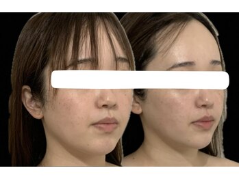 スリーメイ(3mey)/フェイスラインのもたつきオフ