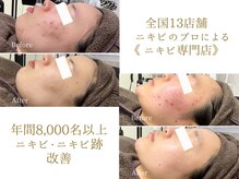 ニキビケア研究所 北千住店/毎年8000名以上のニキビ改善