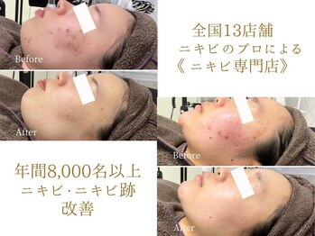 ニキビケア研究所 北千住店/毎年8000名以上のニキビ改善