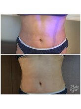 エンドリングフェイシャル専門サロン ムーンティア/インディバ痩身一回でスッキリ！