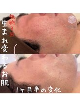 ビジュープラス ひたち野うしく店(Bijou+)/20代【肌荒れ/赤ら顔】