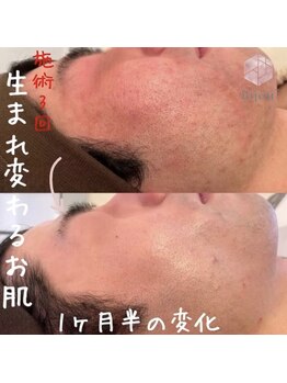 ビジュープラス ひたち野うしく店(Bijou+)/20代【肌荒れ/赤ら顔】