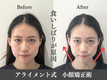 アライメント 自由が丘(Alignment)/食いしばりがエラ張りの原因♪