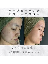 アシュレ リル(assure Lilou)/【ハーブ】Before→After 