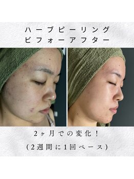 アシュレ リル(assure Lilou)/【ハーブ】Before→After 