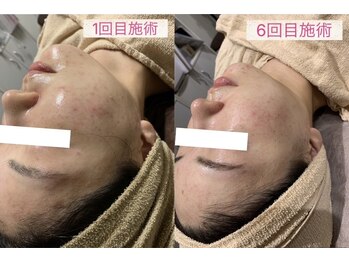 ジョイアビューティー(Gioia beauty)の写真/【韓国肌管理★】リジュランジェネリック×ソフトダーマ導入で繰り返す大人ニキビ改善!!毛穴引き締めケア◎
