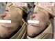 ジョイアビューティー(Gioia beauty)の写真/【韓国肌管理★】リジュランジェネリック×ソフトダーマ導入で繰り返す大人ニキビ改善!!毛穴引き締めケア◎