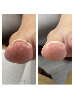 ミミ(mimi)/巻き爪ケア