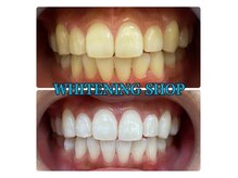 ホワイトニングショップ 天王寺店/10回ご来店後のお写真です