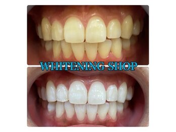 ホワイトニングショップ 天王寺店/10回ご来店後のお写真です