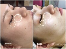 ラウレア(LAULEA)/シミ改善Before/after(2ヶ月)