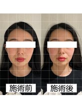 ヴィーライン 大阪梅田院(VeLine)/鍼灸／美容鍼／小顔／大阪／梅田