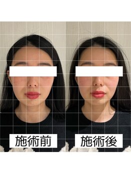 ヴィーライン 大阪梅田院(VeLine)/鍼灸／美容鍼／小顔／大阪／梅田