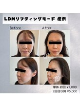 UBメディカルサロン 新宿/LDM(リフティングモード)
