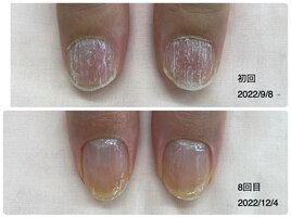 自爪育成