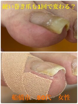 巻き爪じゅん 千葉駅前店/硬い巻き爪も1回で変わる？