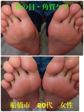 巻き爪じゅん 千葉駅前店/魚の目・ウオノメ・角質ケア