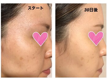 エクレクティック(ECLECTIC)/ピーリング/ホワイトニング