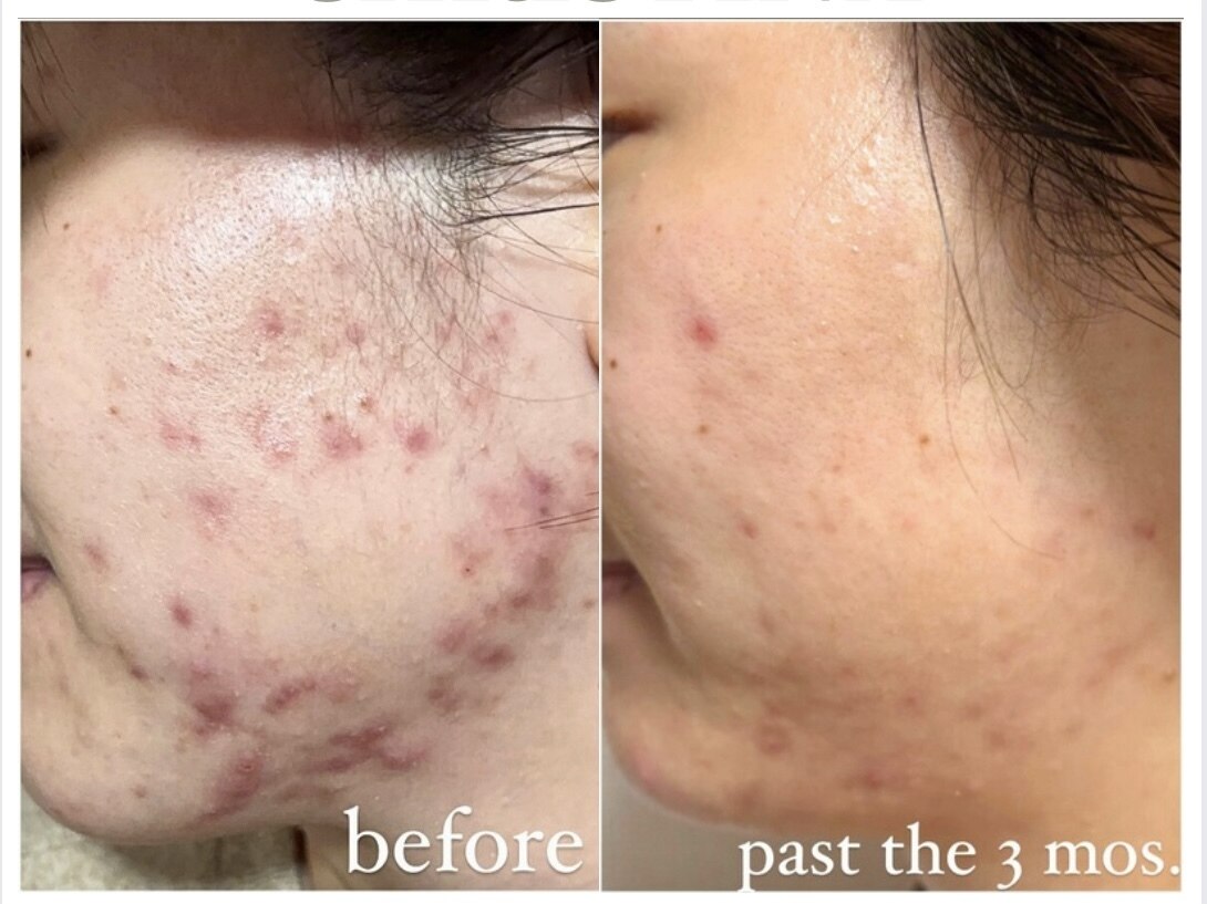 肌質改善エステサロン♡ フォー(For)｜ホットペッパービューティー