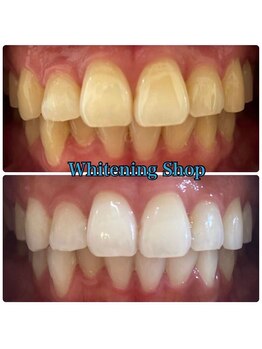 ホワイトニングショップ 吉祥寺店/BEFORE ＆ AFTER