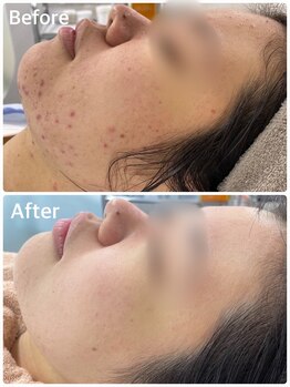 スハダビ110(suhadabi110)/before after