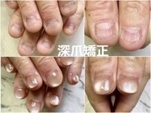 深爪は改善します！長さ出しで矯正！初回から綺麗に！11000円～