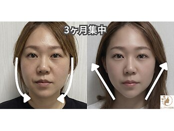 ピュアハリ/沖縄那覇美容鍼灸/小顔/たるみ