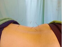 上田鍼灸治療院/○ピンポイント鍼灸もあります○