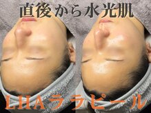 ダリア(Dahlia)の雰囲気（肌弾力・透明感UP！ダウンタイムなく直後から肌質の変化を）