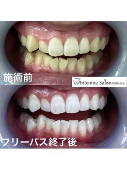 ホワイトニングサロン 京都烏丸店/ホワイトニング施術例