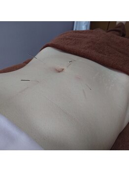 鍼灸ガジュマル/自律神経にも効果的♪