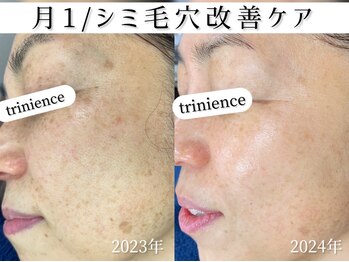 トリニエンス 新宿店(TRINIENCE)/50代/シミケア/肌代謝ケア