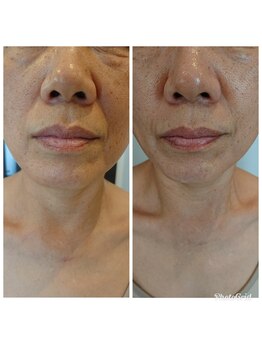 アンクール(esthetic salon uncoeur)/たるみケアや小顔になりたい方に