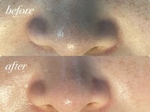 アンドナイン エス店(ANDNINE.)/毛穴洗浄1回