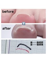 エナジー オブ グレース(energy of grace)/巻き爪ケア